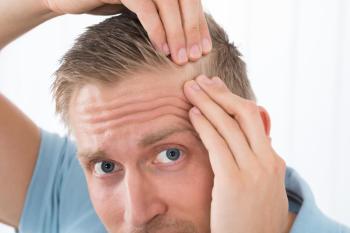 Hair Transplantation